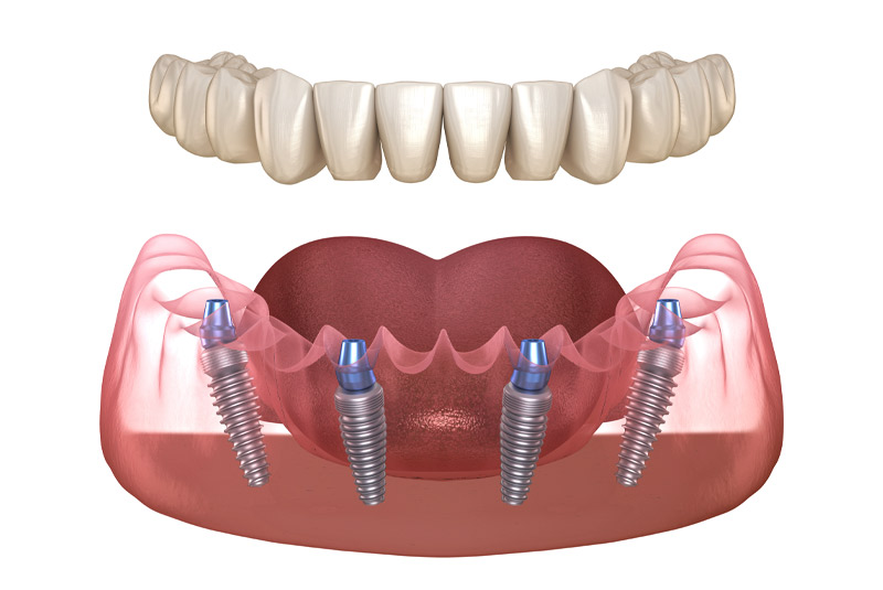 Full mouth dental implants example model