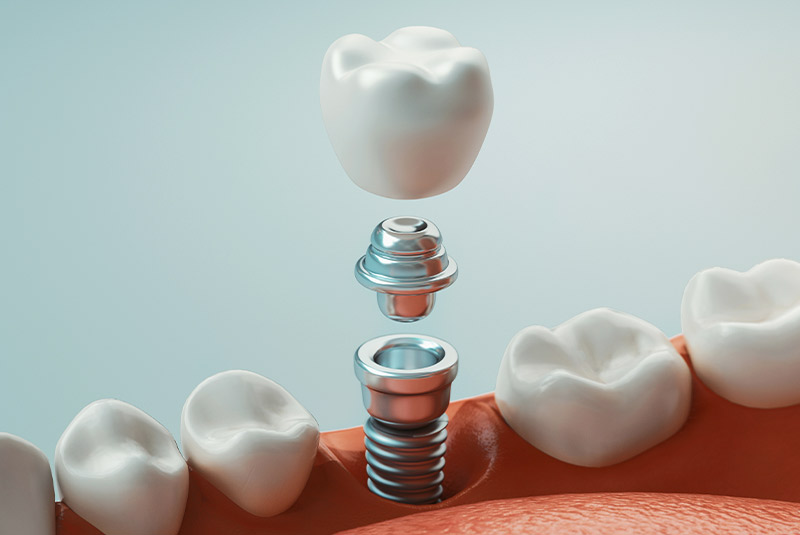 Dental Implant Example Model