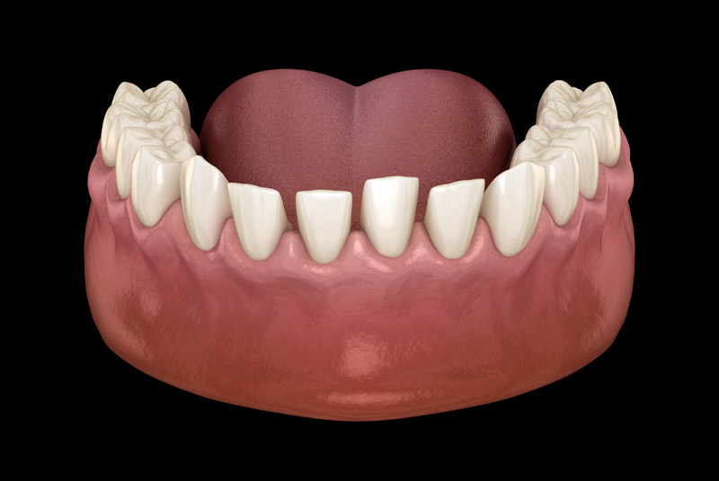 Gapped teeth example model