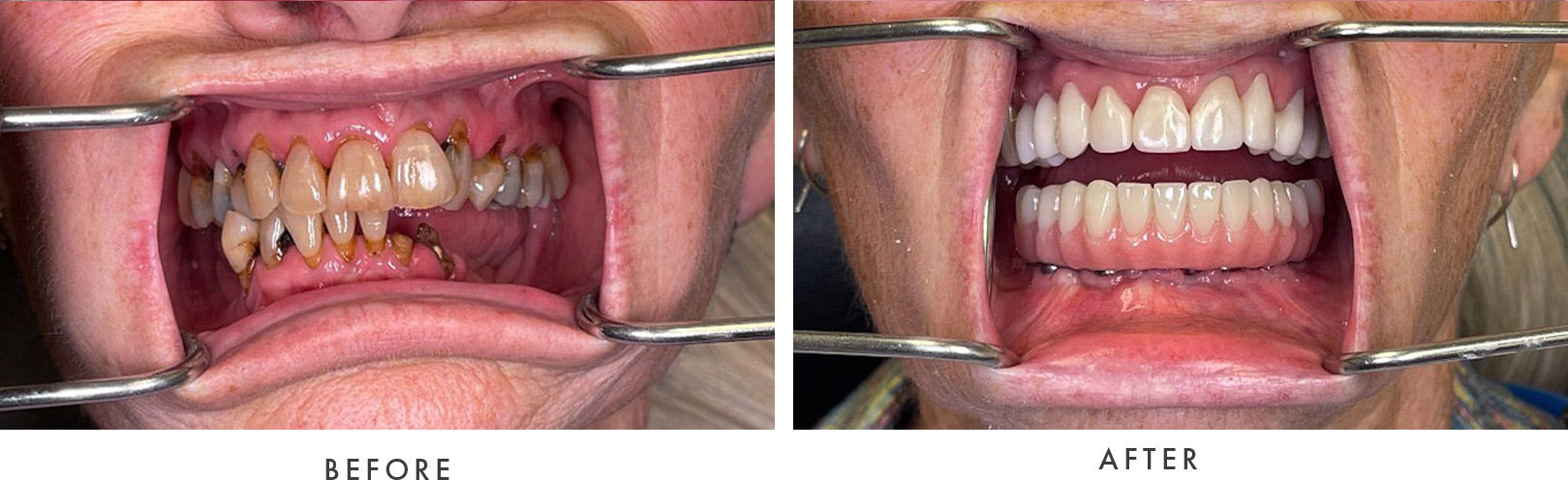 Wellington Family Dentistry & Implant Center before and after example model