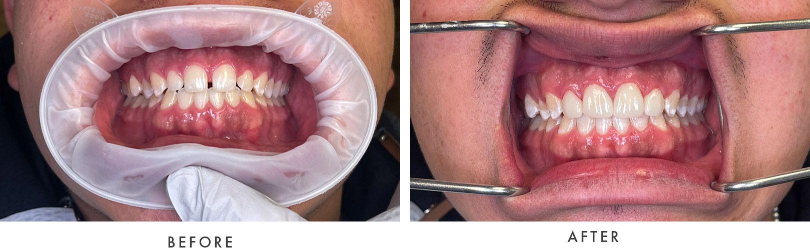 Wellington Family Dentistry & Implant Center before and after example model