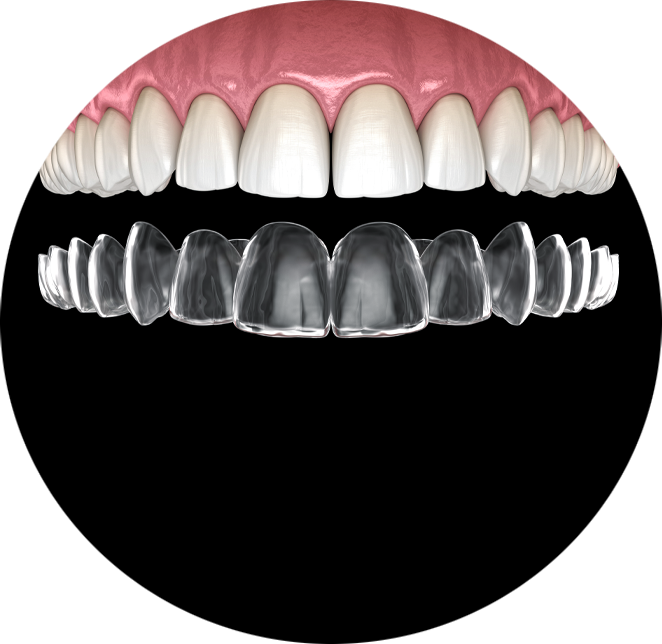 Clear aligners example model