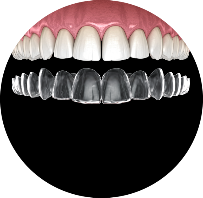 Clear aligners example model