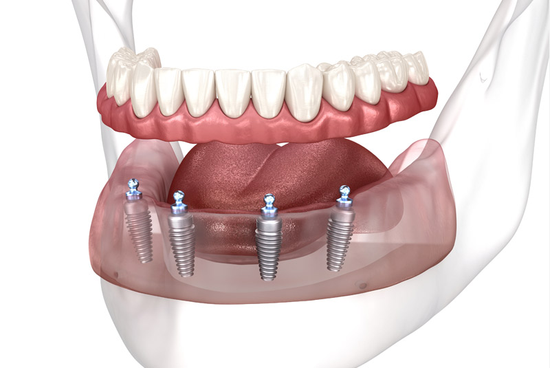 Implant Supported Denture Example Model