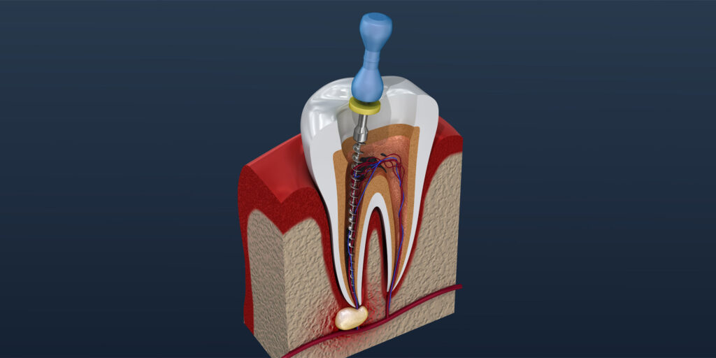 Root Canal Example Model