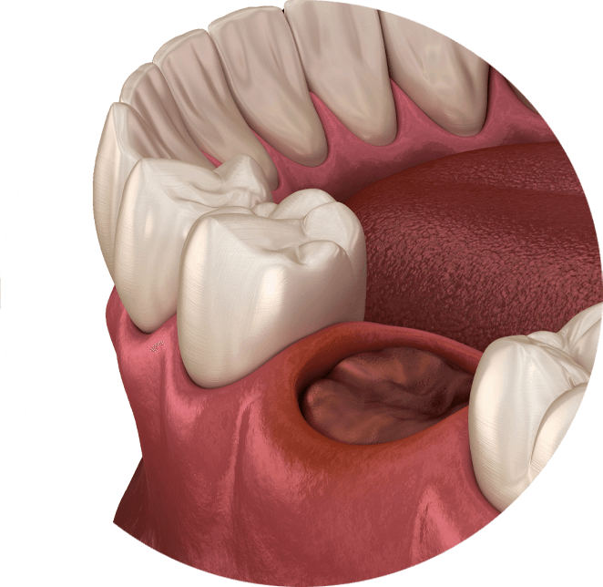 Extracted Tooth Example Model