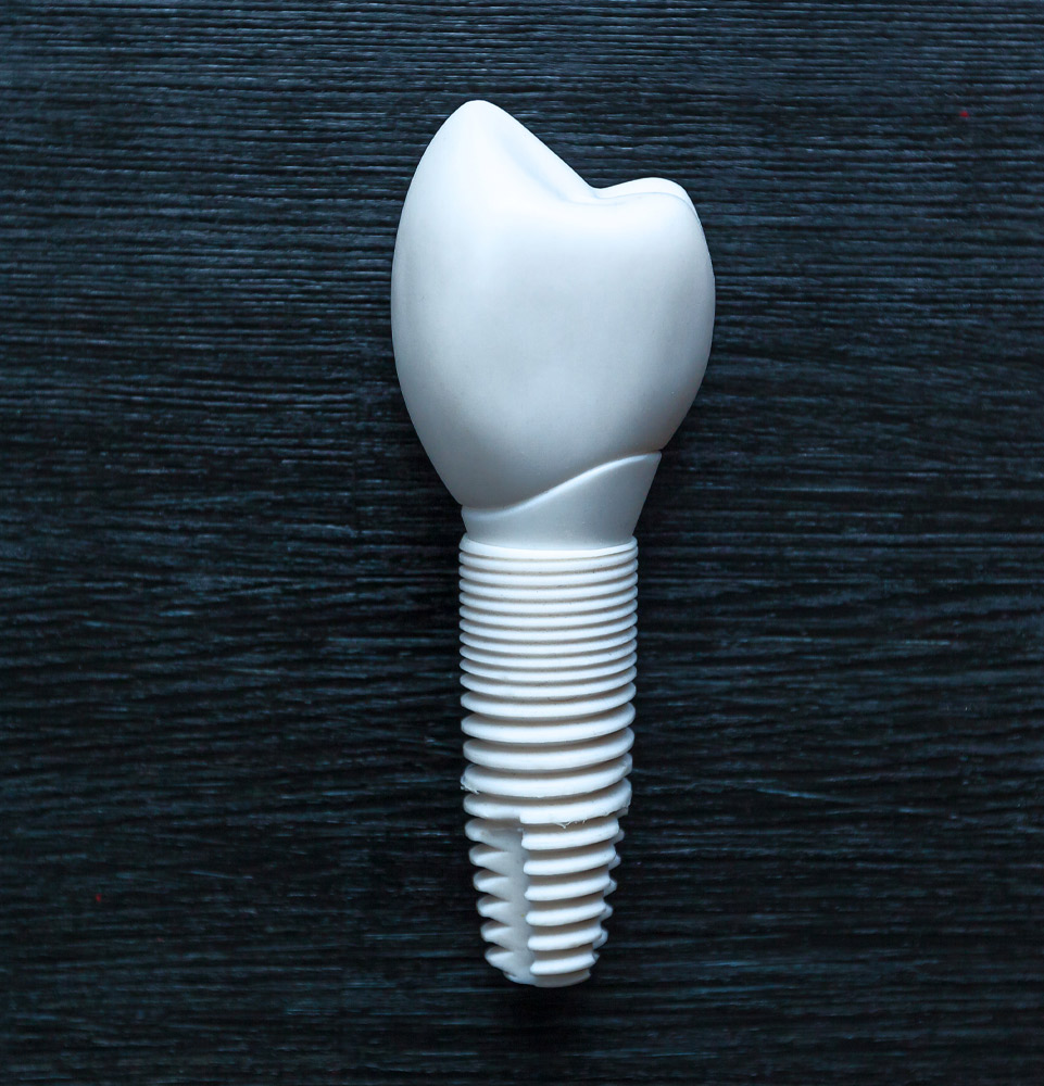 Metal free dental implant example model