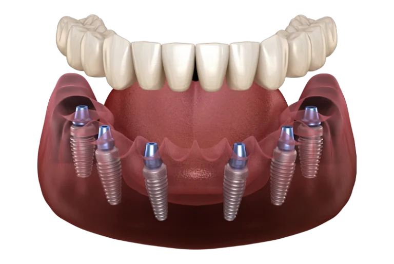 Full Mouth Dental Implants Wellington, CO Wellington Dentistry