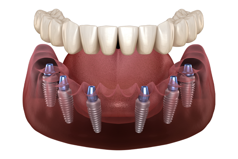 Full mouth dental implant example model