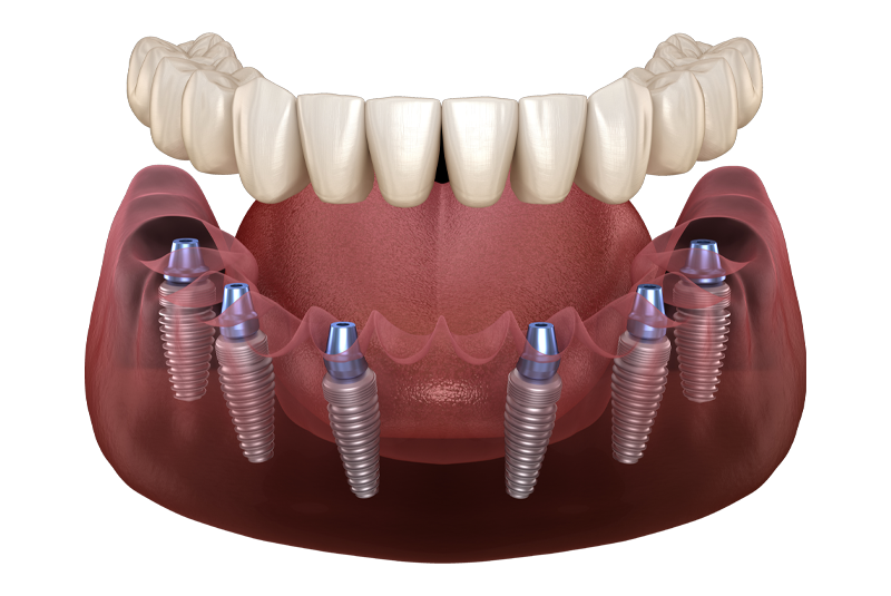 Full mouth dental implant example model