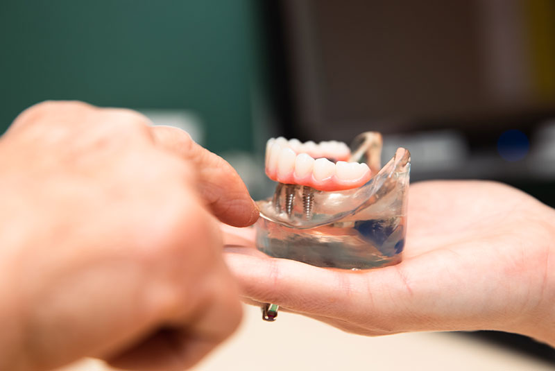 Patient being shown a model of the implant for dental procedure