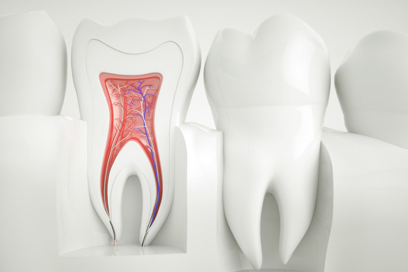 Root canal example model