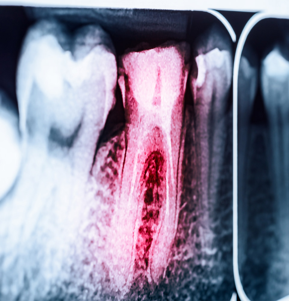 Root canal example model