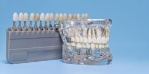 Close-up of a transparent dental implant model with artificial teeth, showcasing metal implants, with a tooth shade guide in the background.