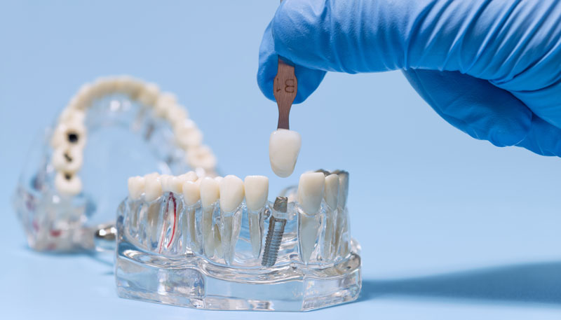 Navigating Dental Implant Risks: Essential Considerations and Safety Insights