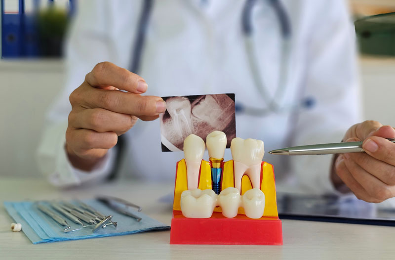 Learn about dental implant replacement—when it's needed, the process, and maintaining oral health for a durable and attractive smile.